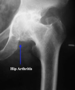 Hip Arthritis Stiff hip loss of joint space cyst formation subchondral sclerosis